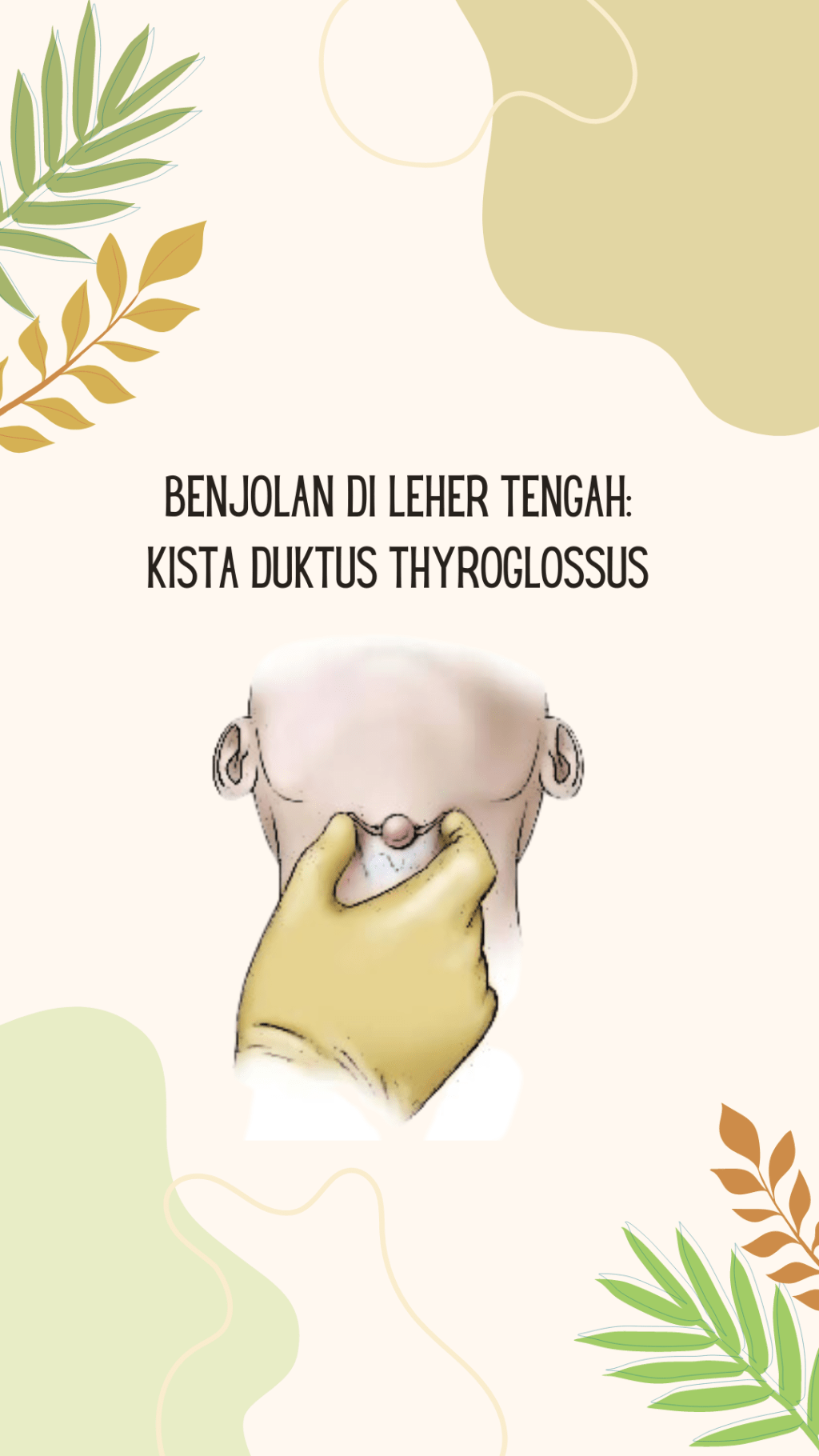 Kista duktus thyroglosus