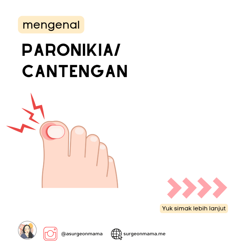 Ingrown toe nail / paronikia/Cantengan